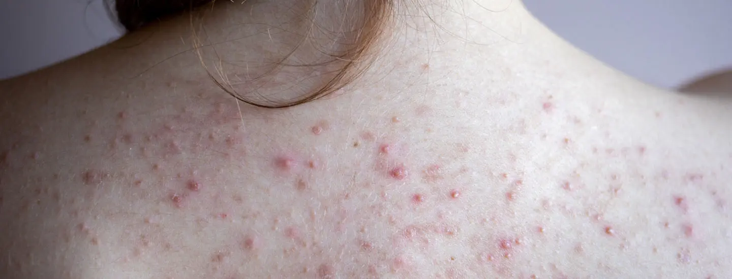 Binsina Laser Clinic - Back Acne