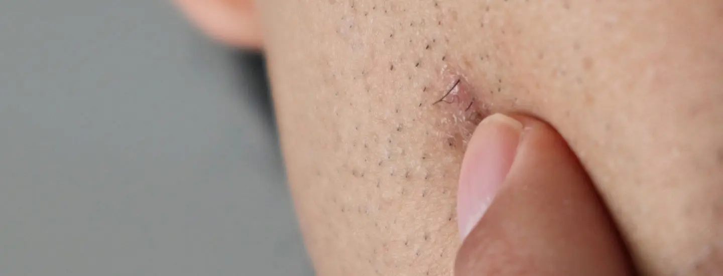 Binsina Laser Clinic - Ingrown Hair Treatment