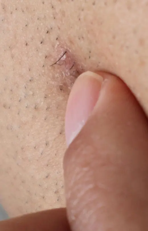 Binsina Laser Clinic - Ingrown Hair Treatment