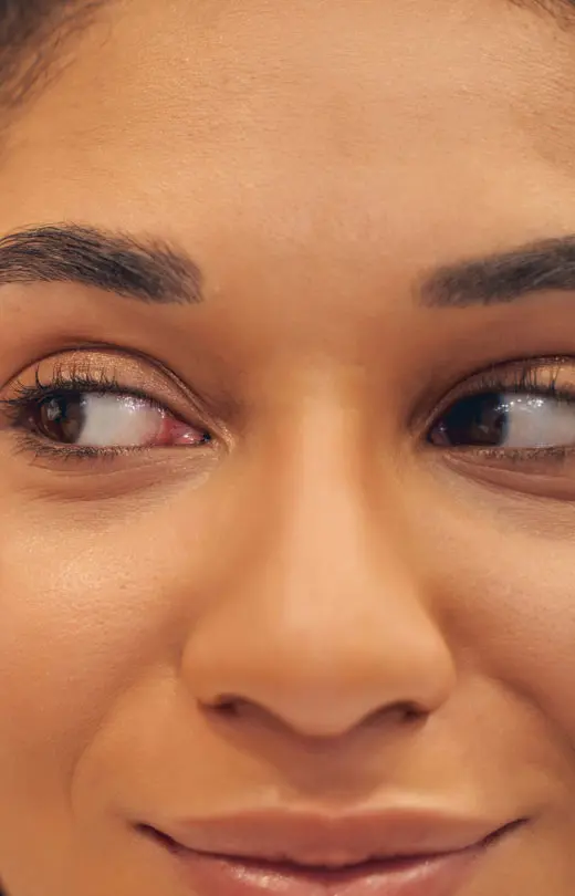 Binsina Laser Clinic - Laser Genesis