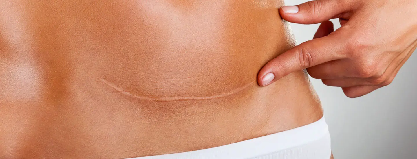 Binsina Laser Clinic - Scar treatment