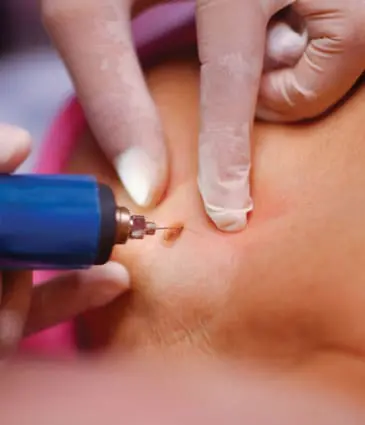 Binsina Laser Clinic - Skin Tag Removal