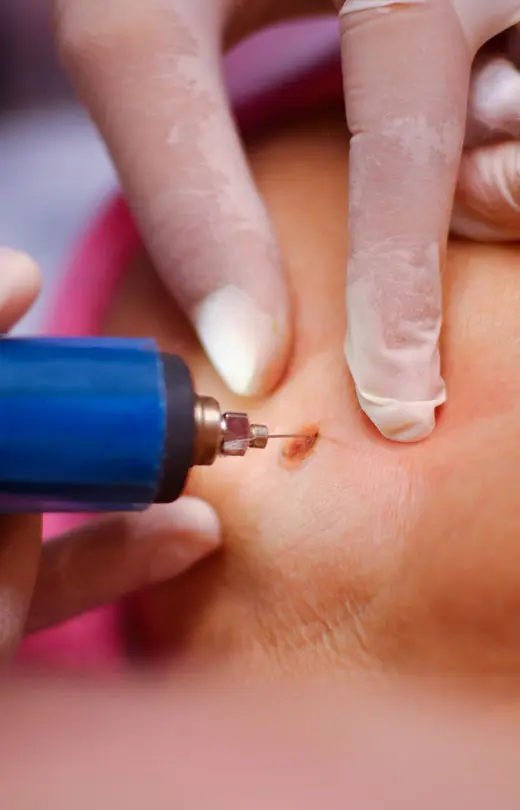 Binsina Laser Clinic - Skin Tag Removal