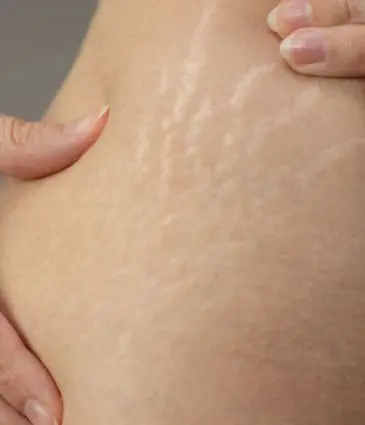 Binsina Laser Clinic - Stretch Marks