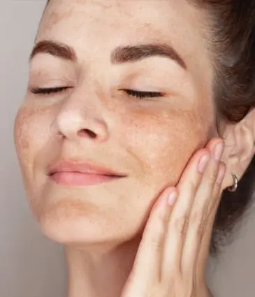 Binsina Skin & Laser Clinic - Age Spots
