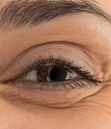 Binsina Skin & Laser Clinic - Crow’s Feet 2