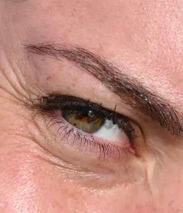 Binsina Skin & Laser Clinic - Crow’s Feet