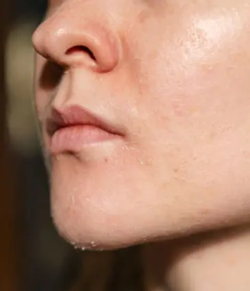 Binsina Skin & Laser Clinic - Dull & Dry Skin 2