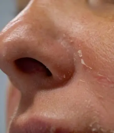 Binsina Skin & Laser Clinic - Eczema