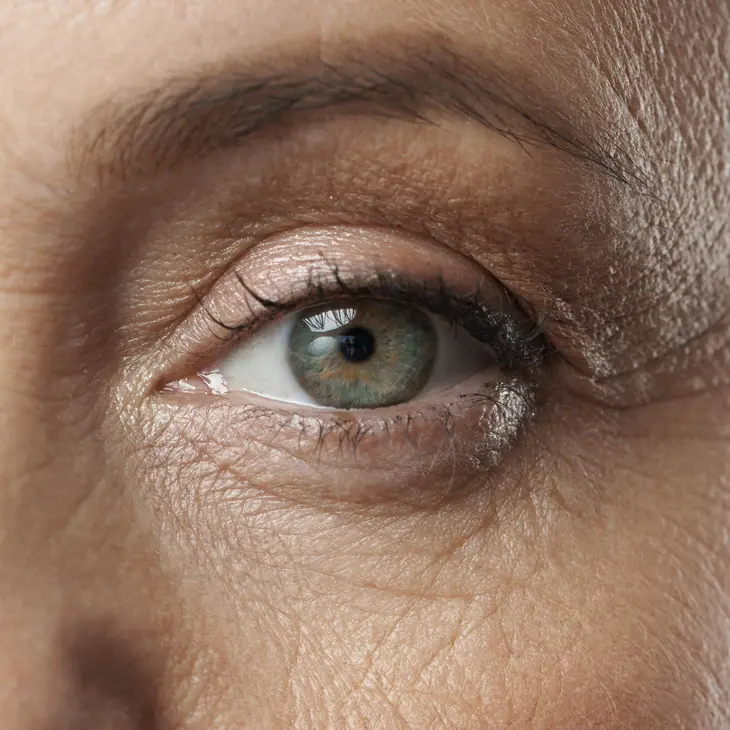 Binsina Skin & Laser Clinic - Eye Bags 3
