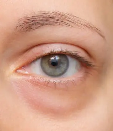 Binsina Skin & Laser Clinic - Eye Bags