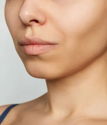 Binsina Skin & Laser Clinic - Facial Volume Loss