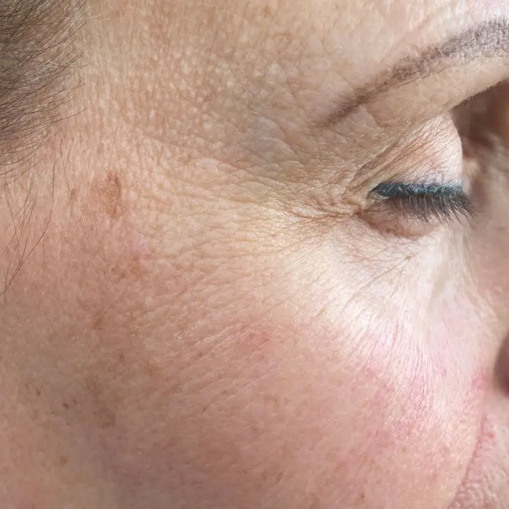 Binsina Skin & Laser Clinic - Fine Lines & Wrinkles 3