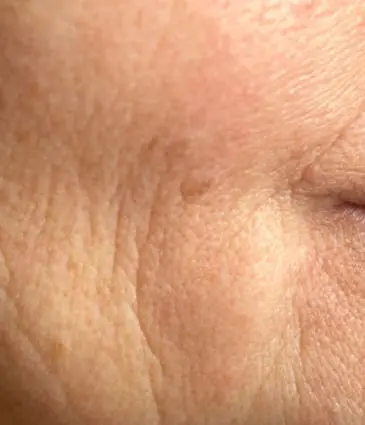 Binsina Skin & Laser Clinic - Fine Lines & Wrinkles