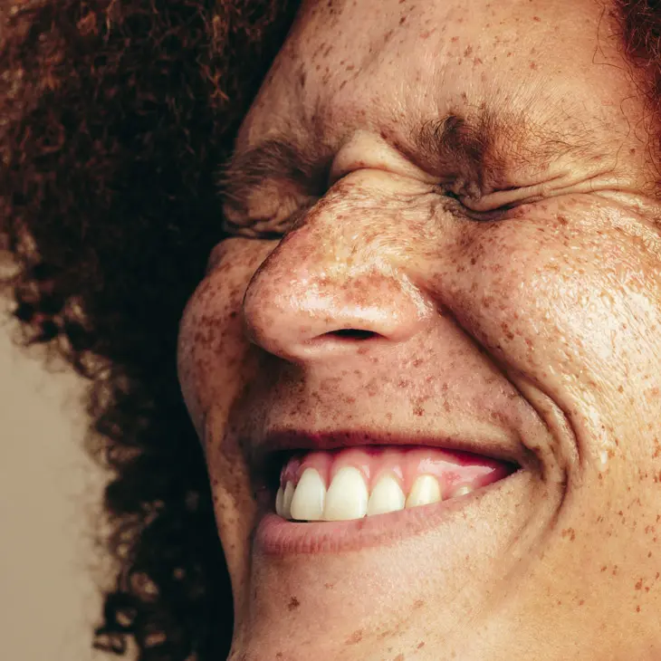 Binsina Skin & Laser Clinic - Freckles 3