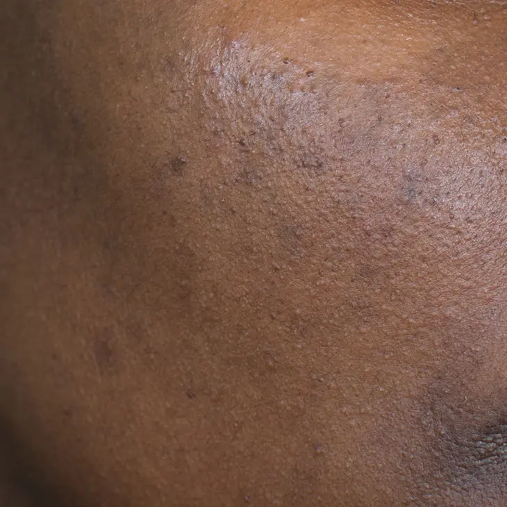 Binsina Skin & Laser Clinic - Hyperpigmentation 3