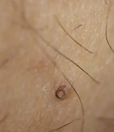 Binsina Skin & Laser Clinic - Ingrown Hair 2