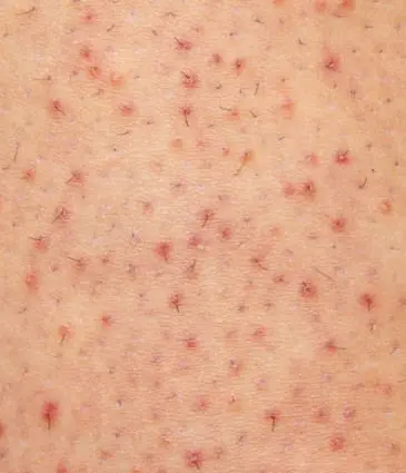 Binsina Skin & Laser Clinic - Keratosis Pilaris 2