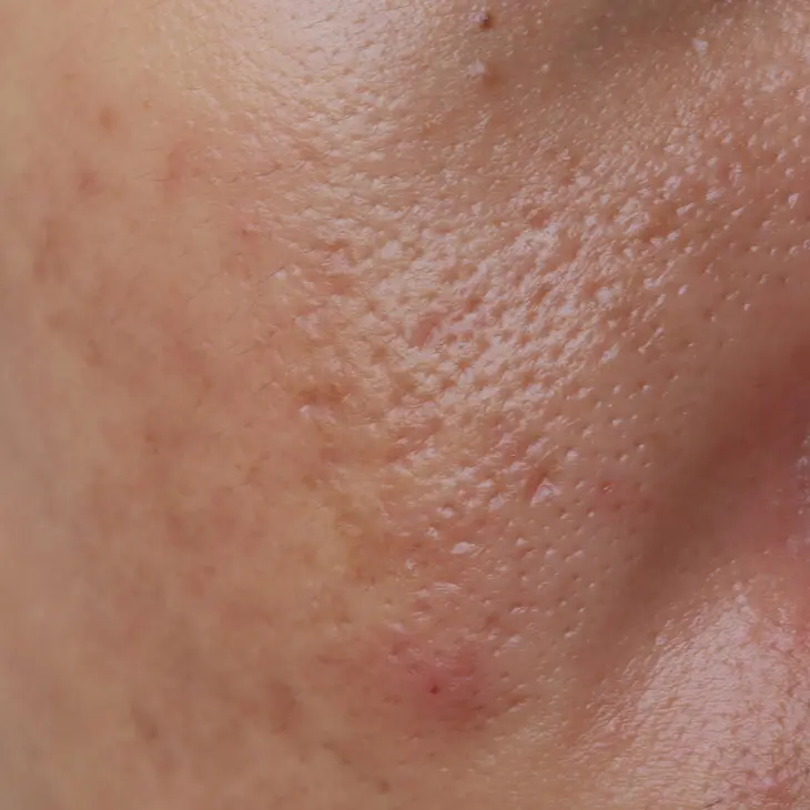 Binsina Skin & Laser Clinic - Large Pores 3