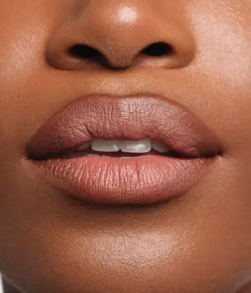 Binsina Skin & Laser Clinic - Lip Fillers 4
