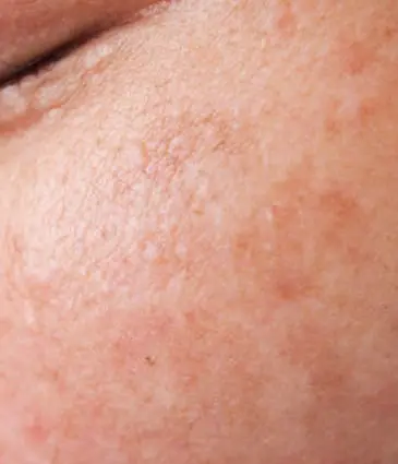 Binsina Skin & Laser Clinic - Melasma 2