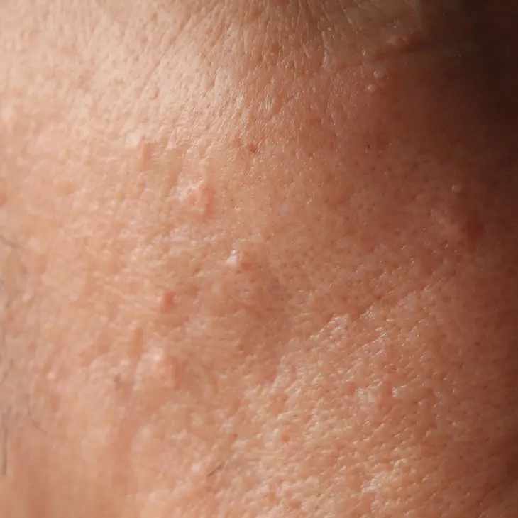 Binsina Skin & Laser Clinic - Milia 3