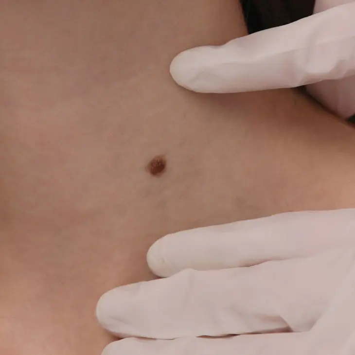 Binsina Skin & Laser Clinic - Mole Removal 2