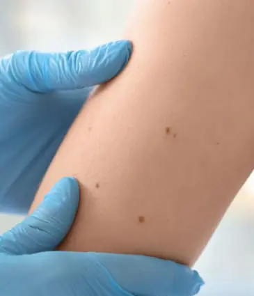 Binsina Skin & Laser Clinic - Moles 2