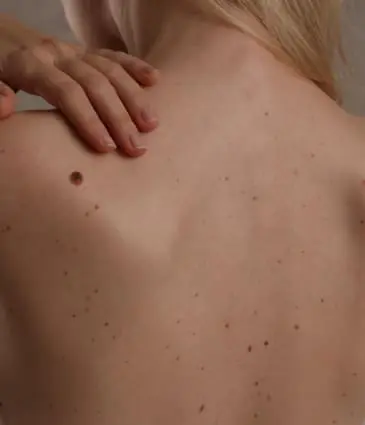 Binsina Skin & Laser Clinic - Moles