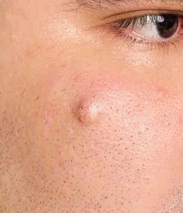 Binsina Skin & Laser Clinic - Sebaceous Cyst 2