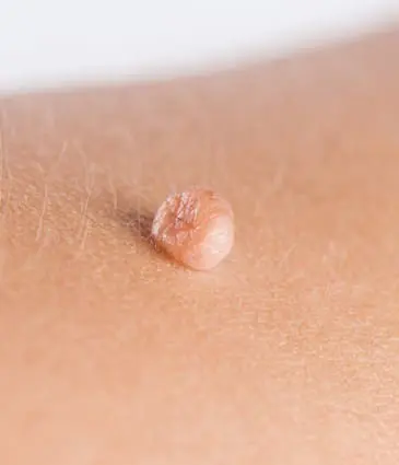 Binsina Skin & Laser Clinic - Skin Tags 2