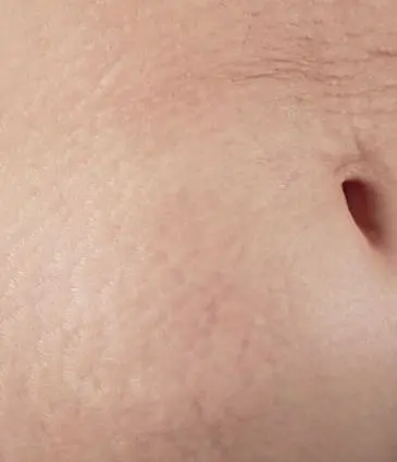 Binsina Skin & Laser Clinic - Stretch Marks 2