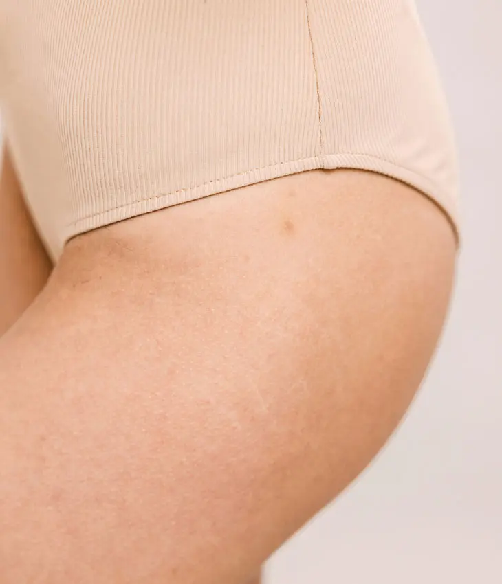 Binsina Skin & Laser Clinic - Stretch Marks 3