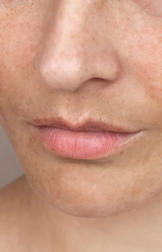 Binsina Skin & Laser Clinic - Sun Damage - Pigmentation