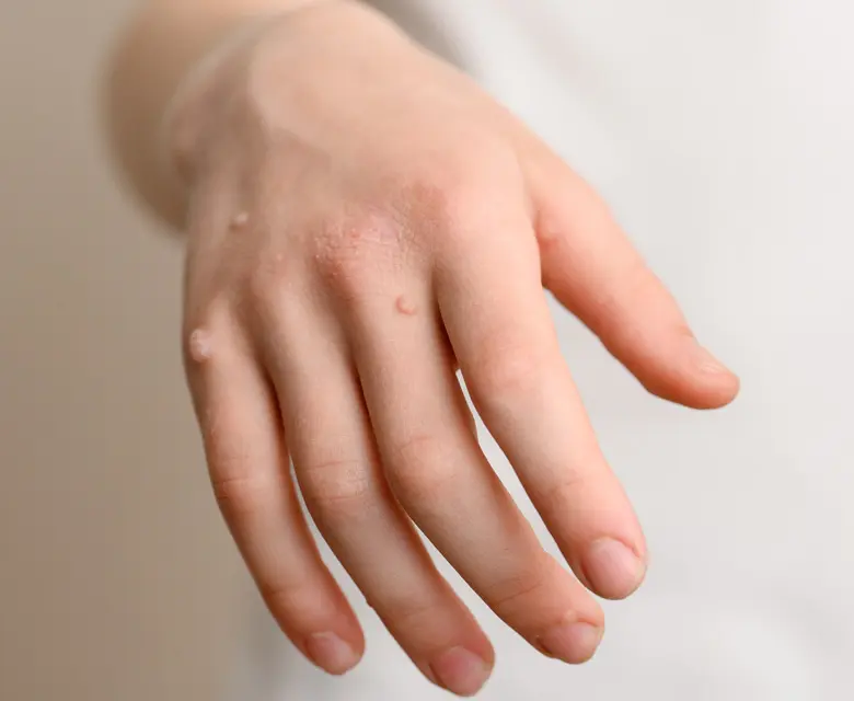 Binsina Skin & Laser Clinic - Warts & Verrucas