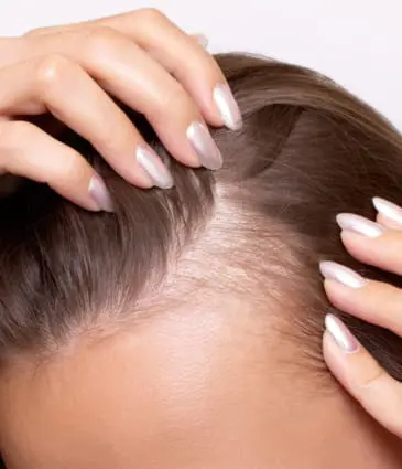 Binsina Skin & Laser Clinic - Thinning Hair - Hair Loss