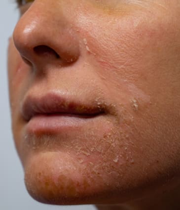 Binsina Skin & Laser Clinic - Sun Damage 2