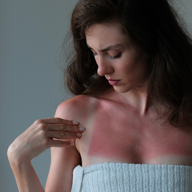 Binsina Skin & Laser Clinic - Sun Damage 3