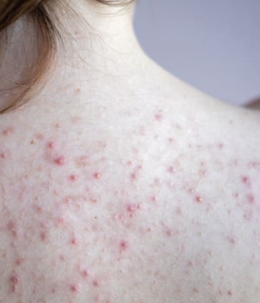 Binsina Laser Clinic - Back Acne