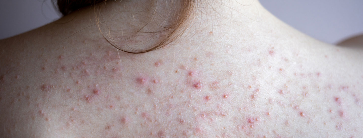 Binsina Laser Clinic - Back Acne