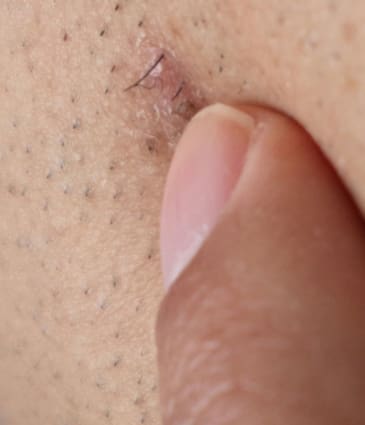 Binsina Laser Clinic - Ingrown Hair Treatment