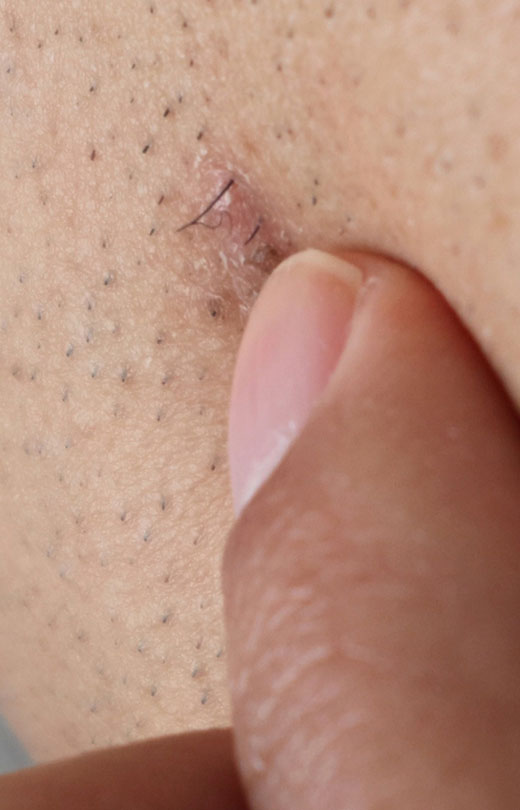 Binsina Laser Clinic - Ingrown Hair Treatment