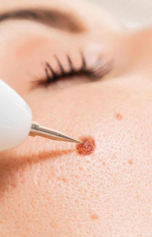Binsina Laser Clinic - Mole Removal