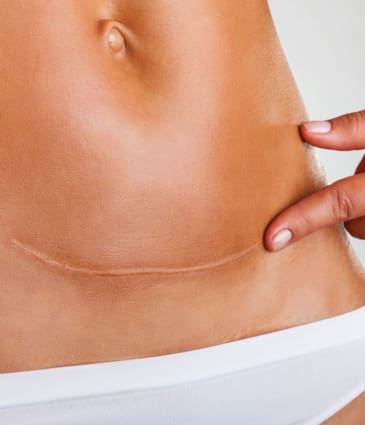 Binsina Laser Clinic - Scar treatment