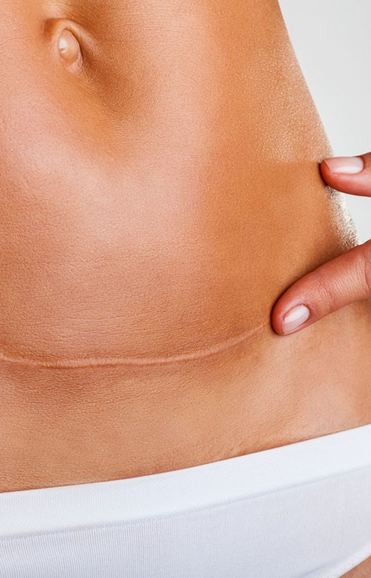 Binsina Laser Clinic - Scar treatment