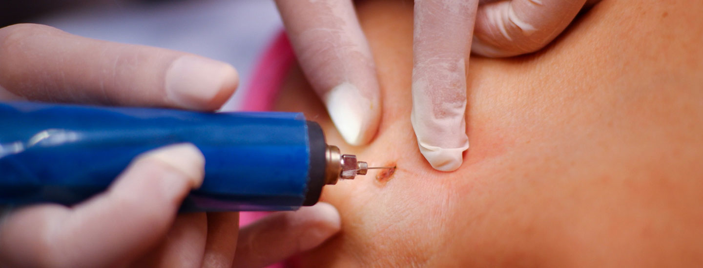 Binsina Laser Clinic - Skin Tag Removal