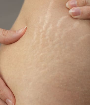 Binsina Laser Clinic - Stretch Marks