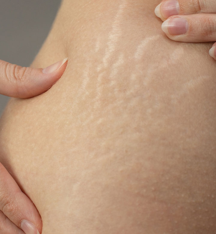 Binsina Laser Clinic - Stretch Marks