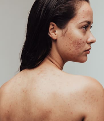 Binsina Skin & Laser Clinic - Acne (Face & Body) 2