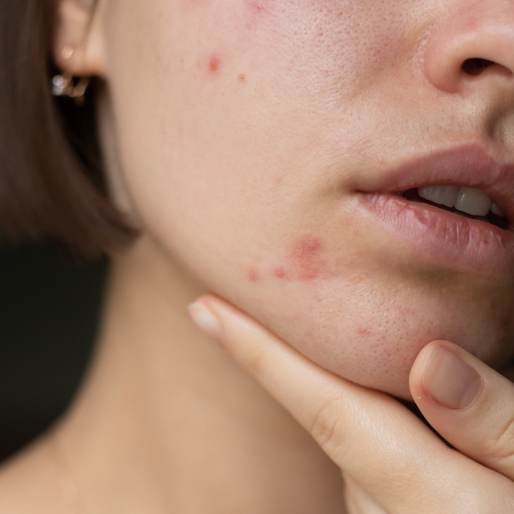 Binsina Skin & Laser Clinic - Acne (Face & Body) 3